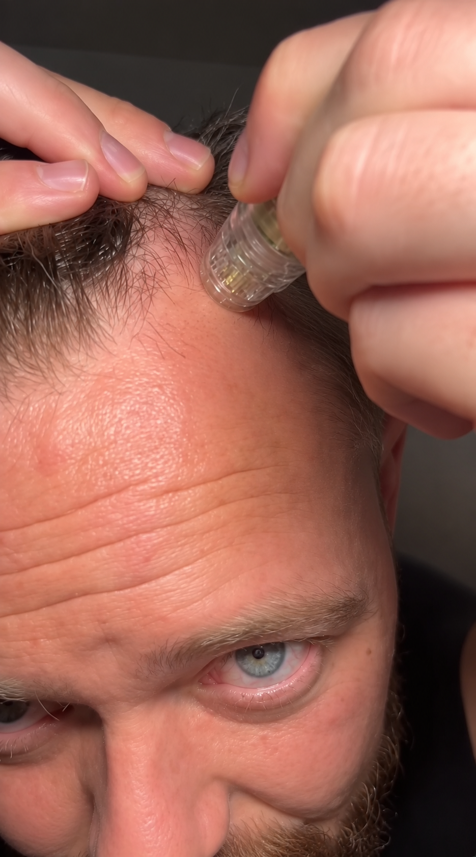 Say Goodbye to Thinning Hair, Receding Hairlines, and Weak, Lifeless Follicles