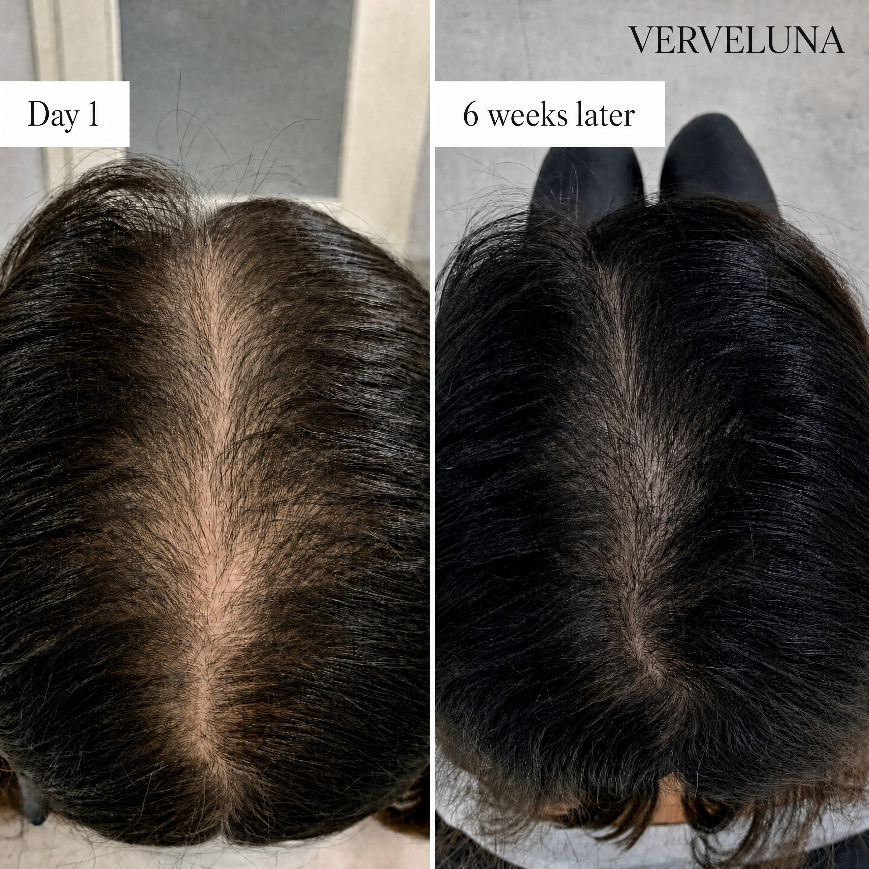 Verveluna ™ Hair Regrowth 2.0 Adenosine & Copper Peptide Micro-Infusion System