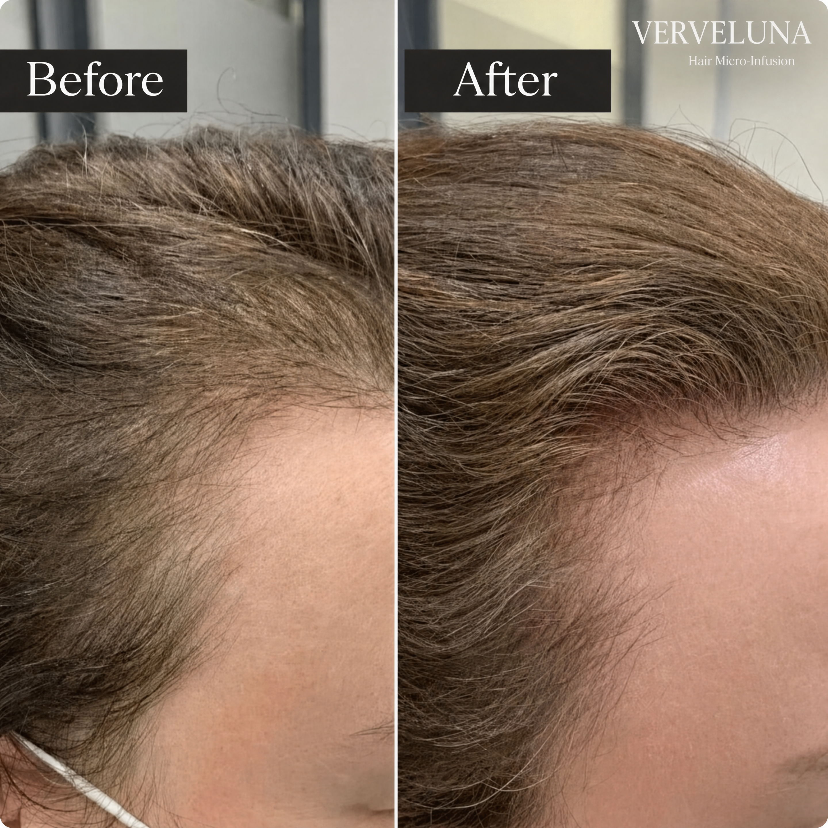 Verveluna ™ Hair Regrowth 2.0 Adenosine & Copper Peptide Micro-Infusion System