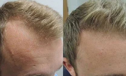 Hair Growth Roll-On Serum