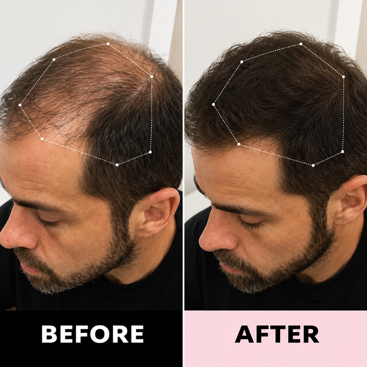 Verveluna ™ Hair Regrowth 2.0 Adenosine & Copper Peptide Micro-Infusion System